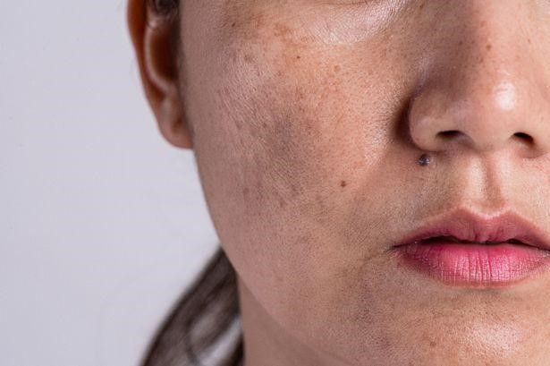 How to remove dark spots without makeup