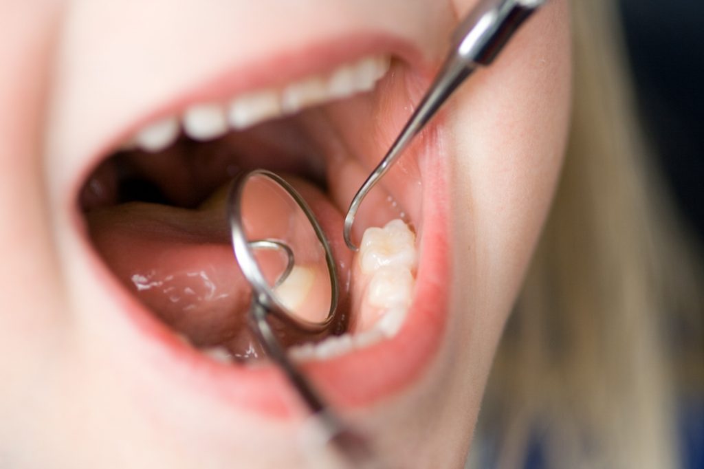 dental plaque removal